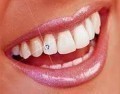 Dental Jewellery - Multi color