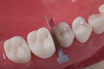 Directa FenderWedge Prep Dental Wedge