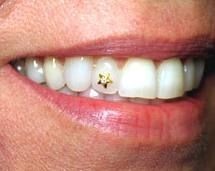 Dental Jewelry - Star - 22kt gold