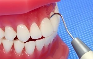 Dental Display / Consultation Model