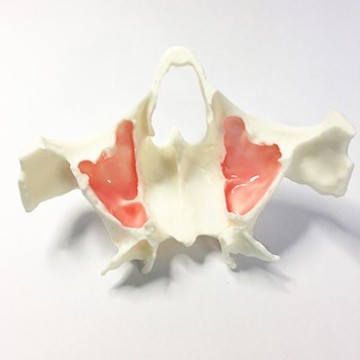 Zygomatic implant sinus dental model