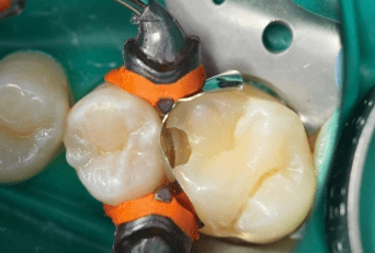 Garrison Dental 3D Composi-tight Ring Sectional Matrix system
