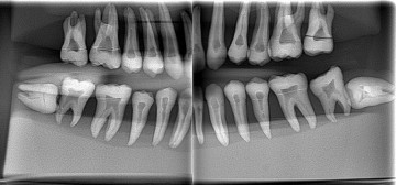 Radio-opaque X-Ray Dental Model